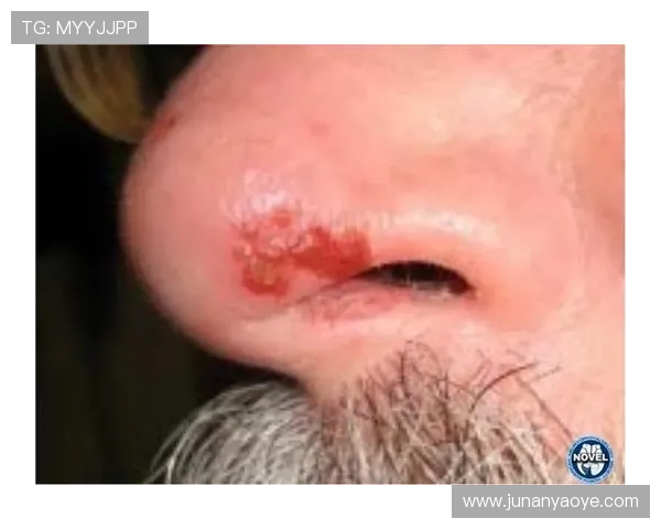 染上带状疱疹折磨哈利伯顿 服药致体重增加